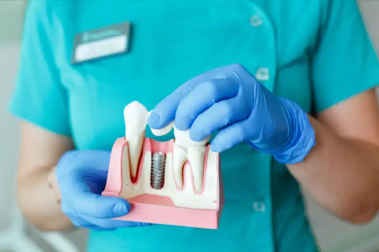 How-Long-Do-Dental-Implants-Last-Google